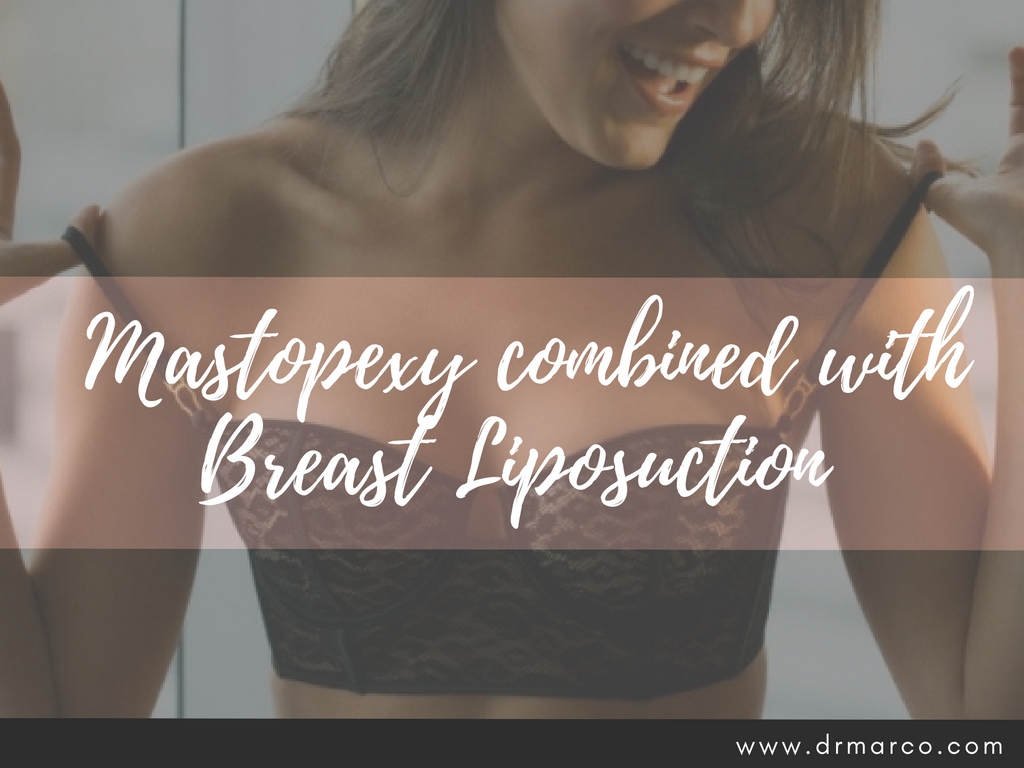 Should Mastopexy be Combined with Breast Liposuction? - Dr Marco