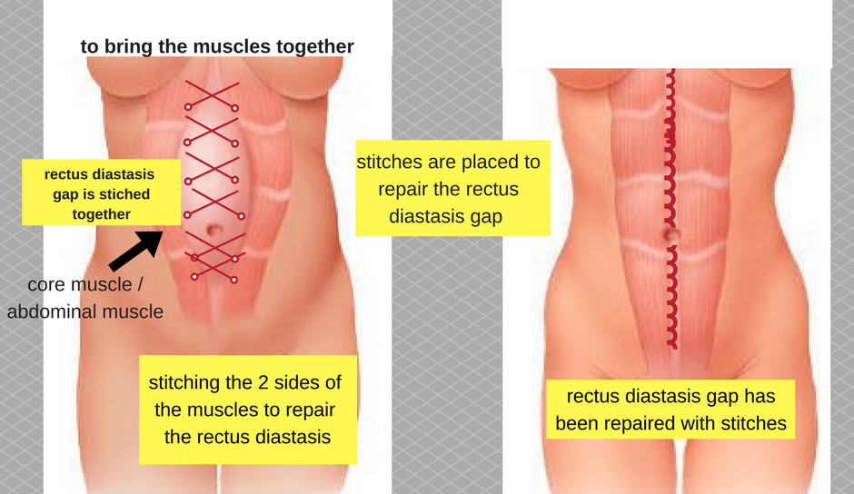 What is Diastasis Recti and can it be fixed?